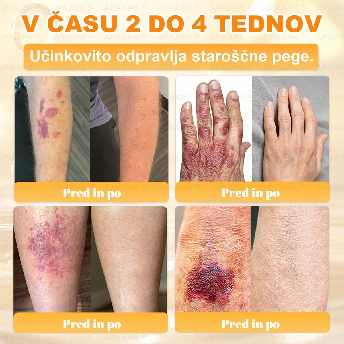 🐝 Časovno omejena ponudba | APKAPK® krema s čebeljim strupom za obnovo kože in zmanjšanje videza gub 🍃 Ciljno delovanje proti gubam in za nego kože z različnimi nepravilnostmi.