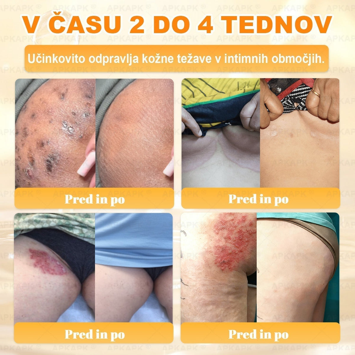 🐝 Časovno omejena ponudba | APKAPK® krema s čebeljim strupom za obnovo kože in zmanjšanje videza gub 🍃 Ciljno delovanje proti gubam in za nego kože z različnimi nepravilnostmi.